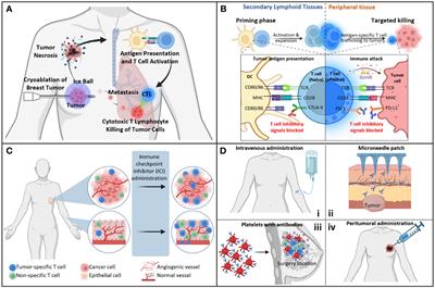 Leveraging cryoablation and checkpoint inhibitors for high-risk triple negative breast cancer